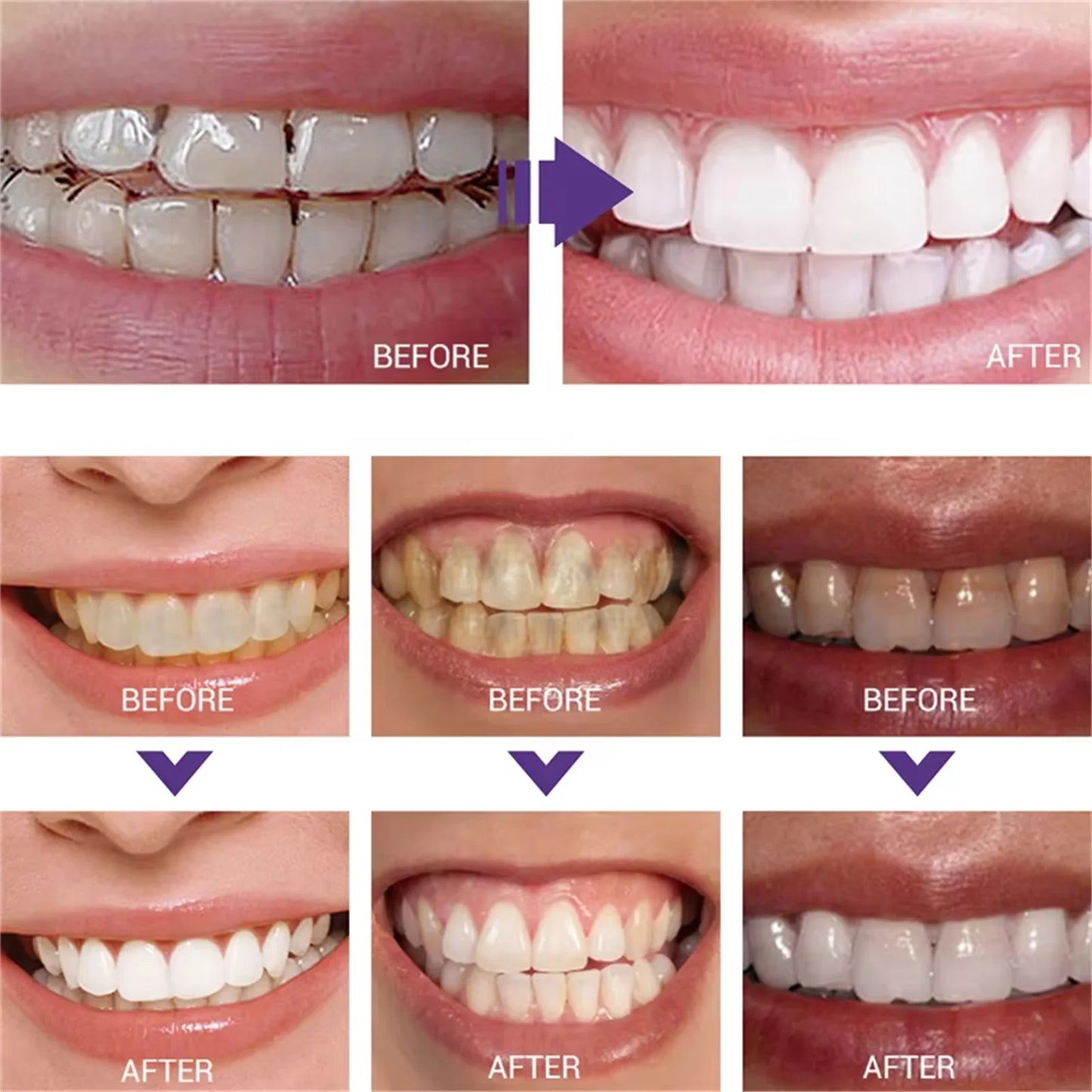 Before and after dental treatment images showing white teeth.