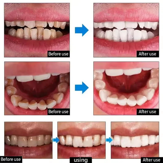 Before and after comparison of teeth whitening using a dental product.