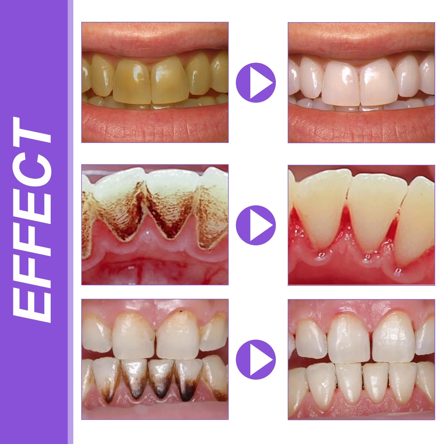 Before and after dental whitening process shown on a grid with visible effects.