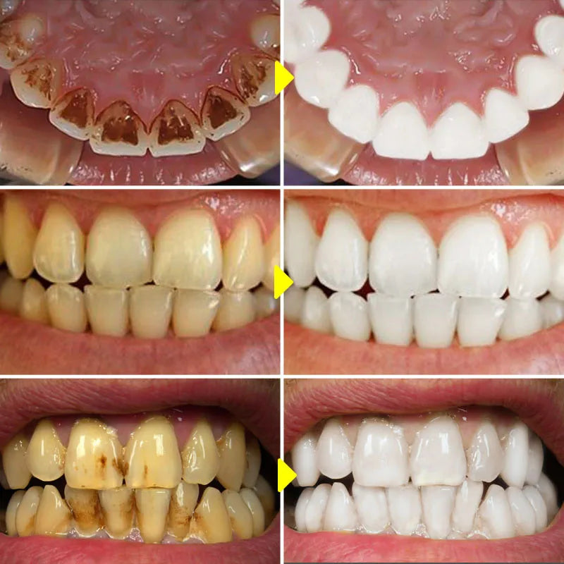 Before and after comparison of teeth whitening treatment.
